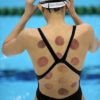 Sport et acupuncture