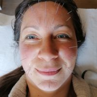 photo aculifting P3 photo aculifting P3